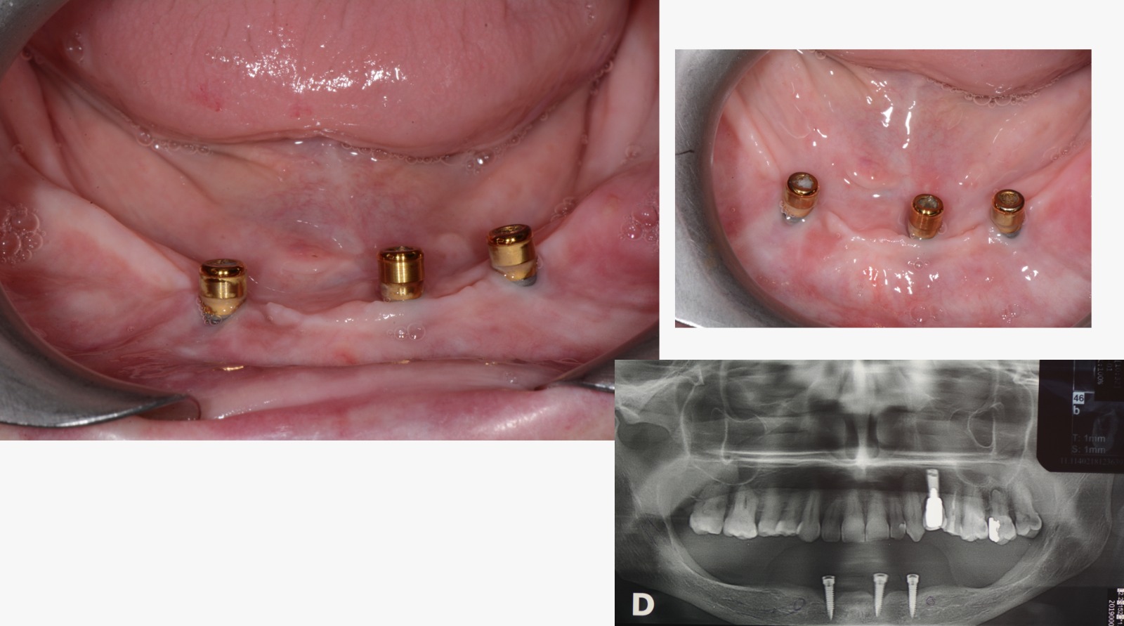 perimplantiti