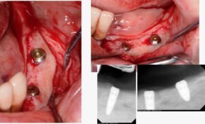 perimplantiti