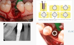 Perimplantiti