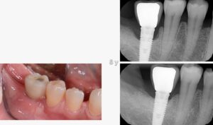 Perimplantiti